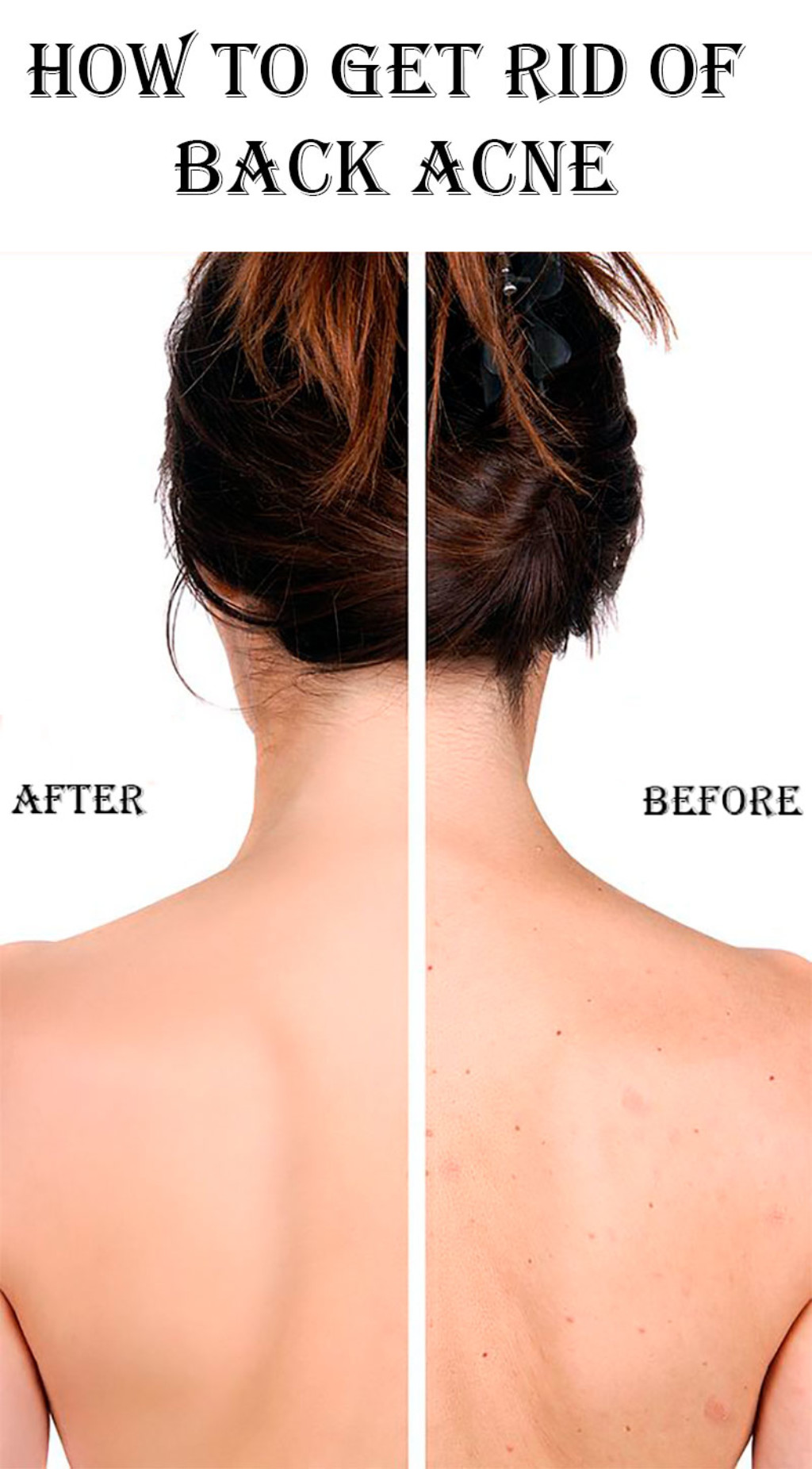 How To Get Rid Of Back Acne Stylish Belles